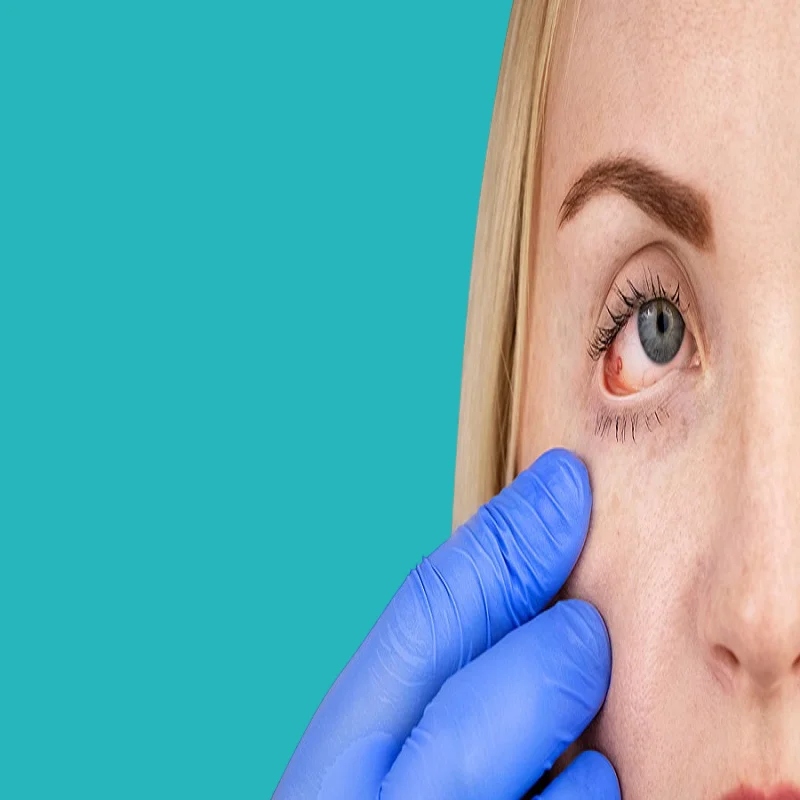 علاج التجمع الدموي في بياض العين واسبابه 