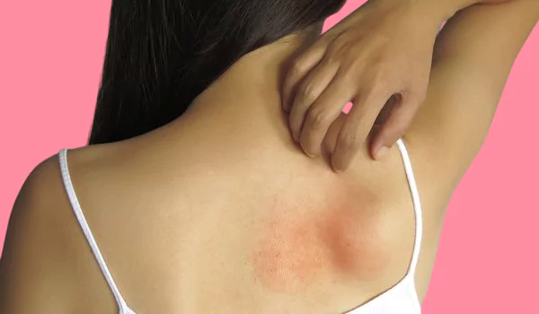 urticaria