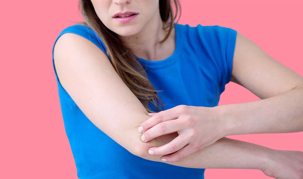 Eczema 