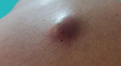 اعراض الخراج