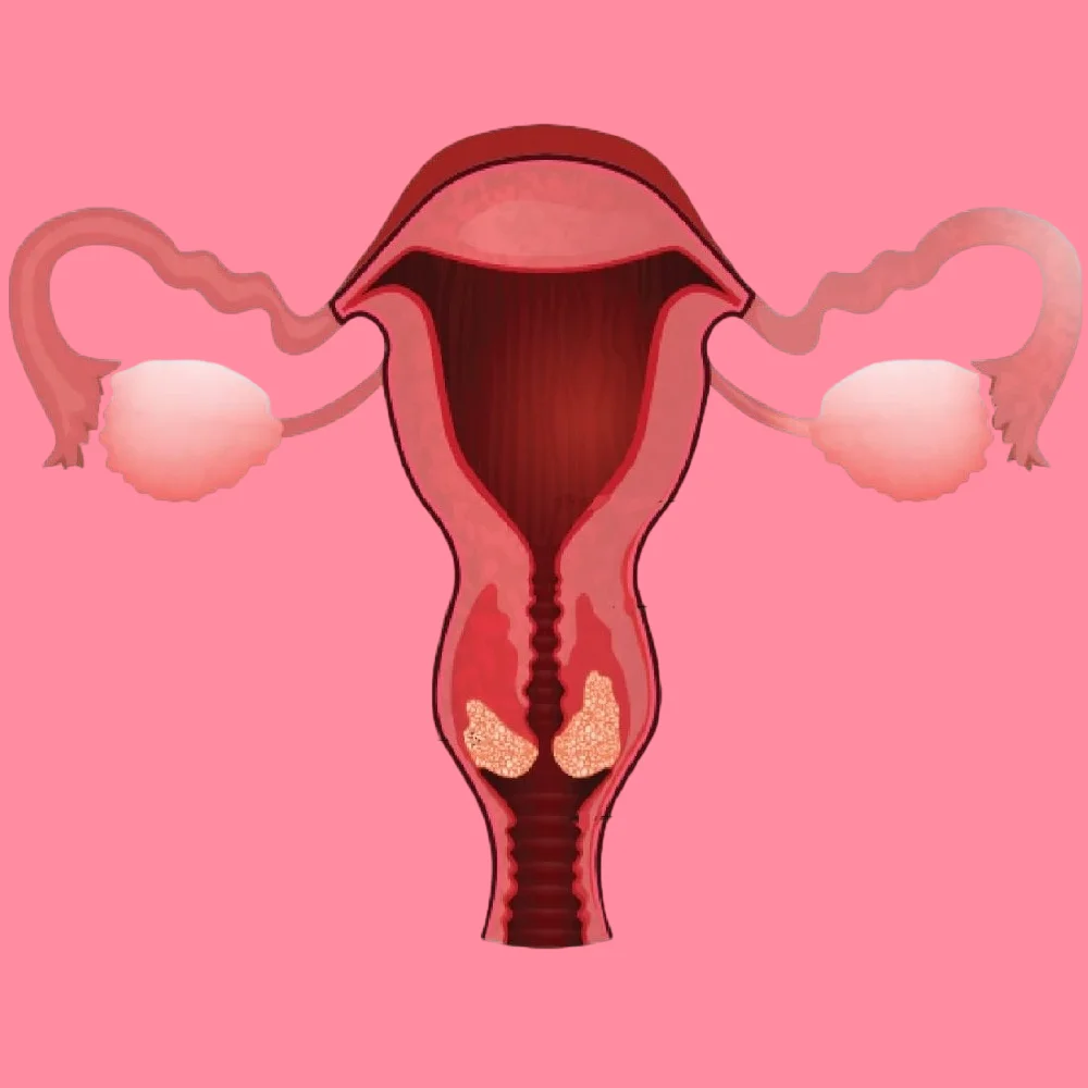 symptoms of cervical cancer in women 