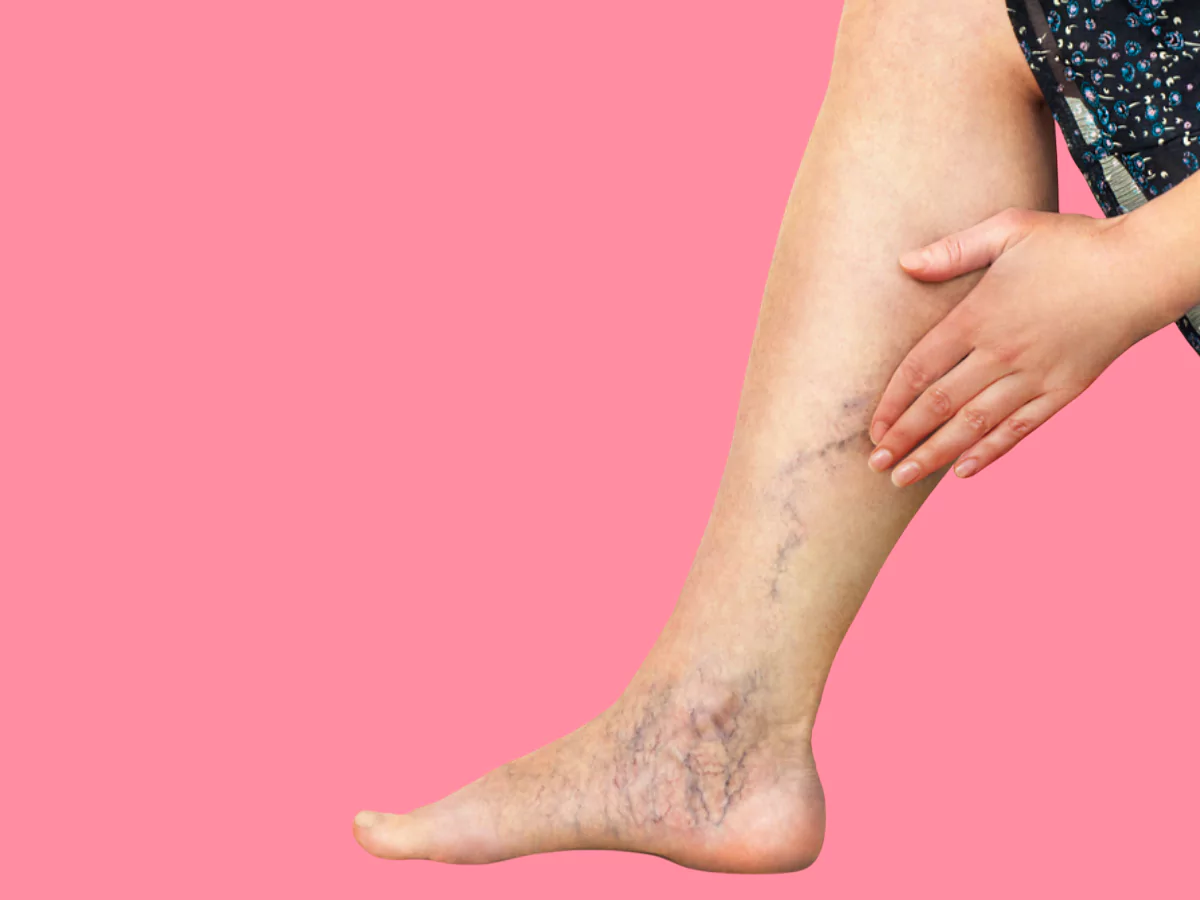 varicose veins 
