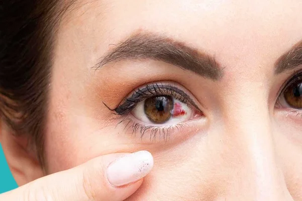 ظهور دم في الجزء الامامي من العين من اعراض التجمع الدموي في بياض العين