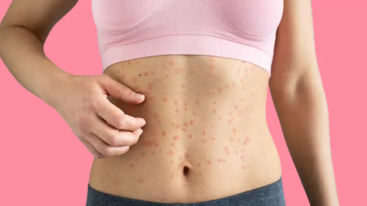 psoriasis 