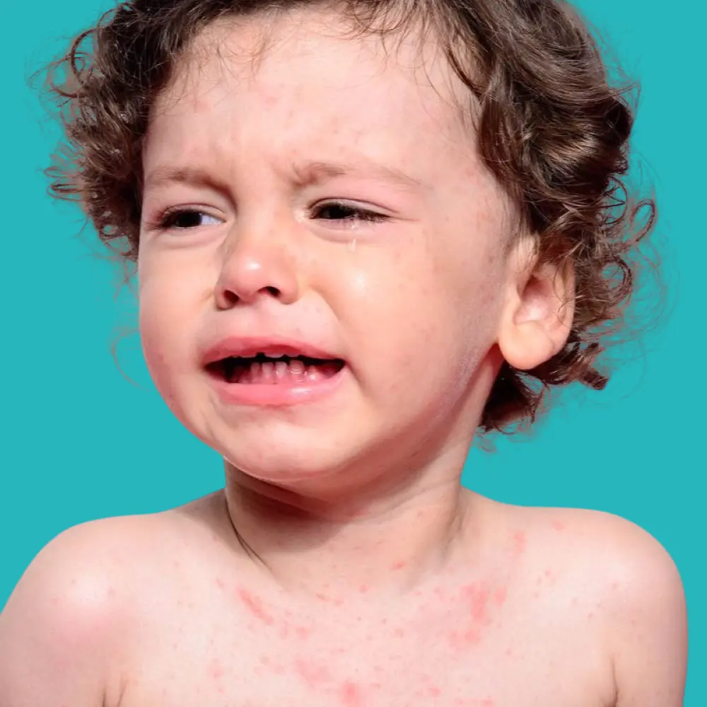 Types of heat rash in children and treatment methods 