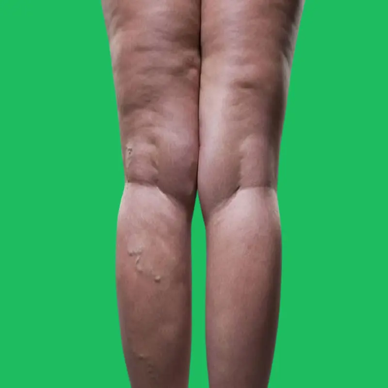 كيفية التخلص من الماء الزائد بالجسم 