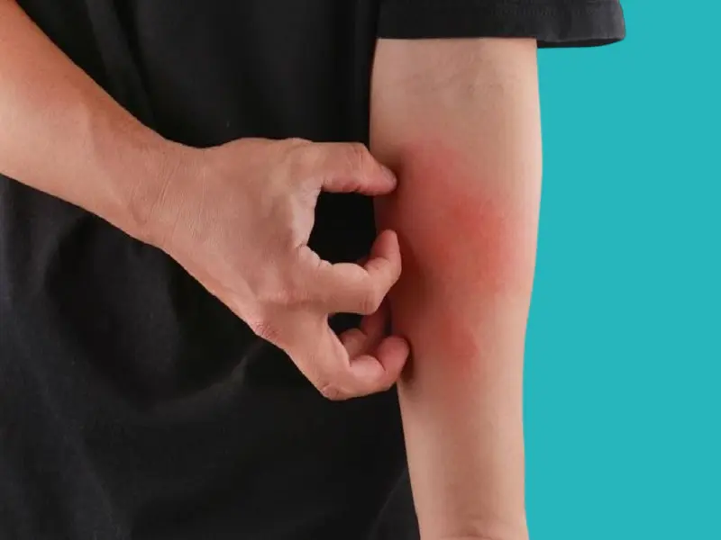 التورم و احمرار الجلد من اعراض مرض الحمرة