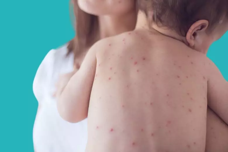 Causes of measles in children