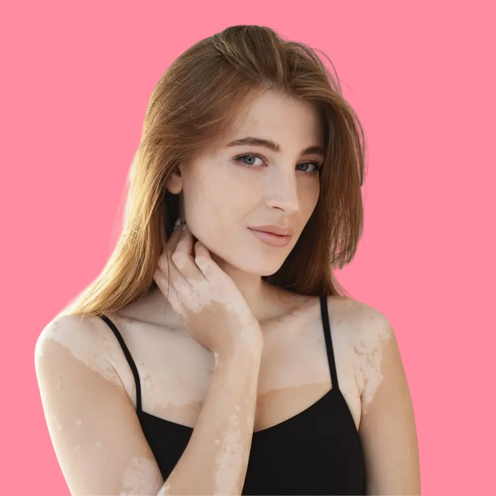 What is vitiligo and its psychological impact on women? 