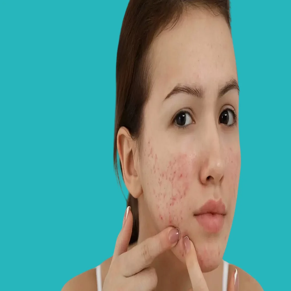 what is the difference between hormonal and bacterial acne? 