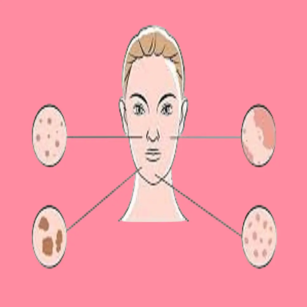 Melasma in women its causes and treatment 
