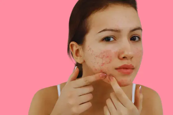 The appearance of pimples and fat