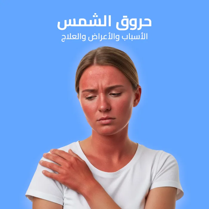 حروق الشمس: الأسباب والأعراض والعلاج 