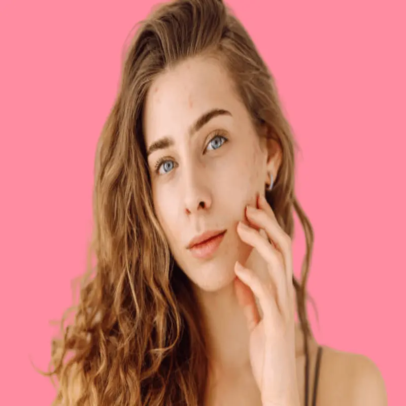 Effective natural acne treatments 