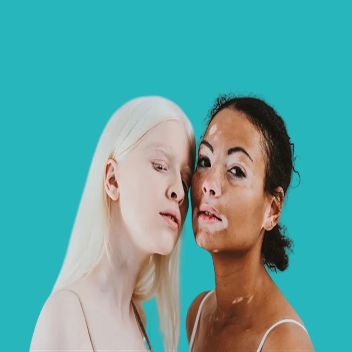 what is the difference between albinism and vitiligo and their symptoms? 