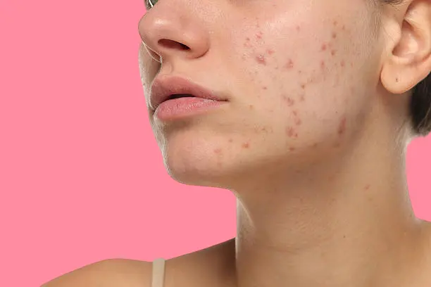 الحالة النفسية ونضارة البشرة