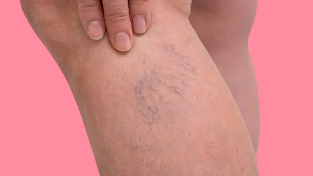 Varicose veins in older women