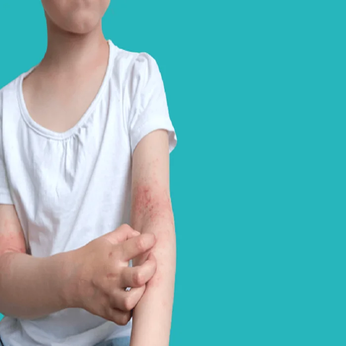 افضل دواء لعلاج الصدفية عند الاطفال 