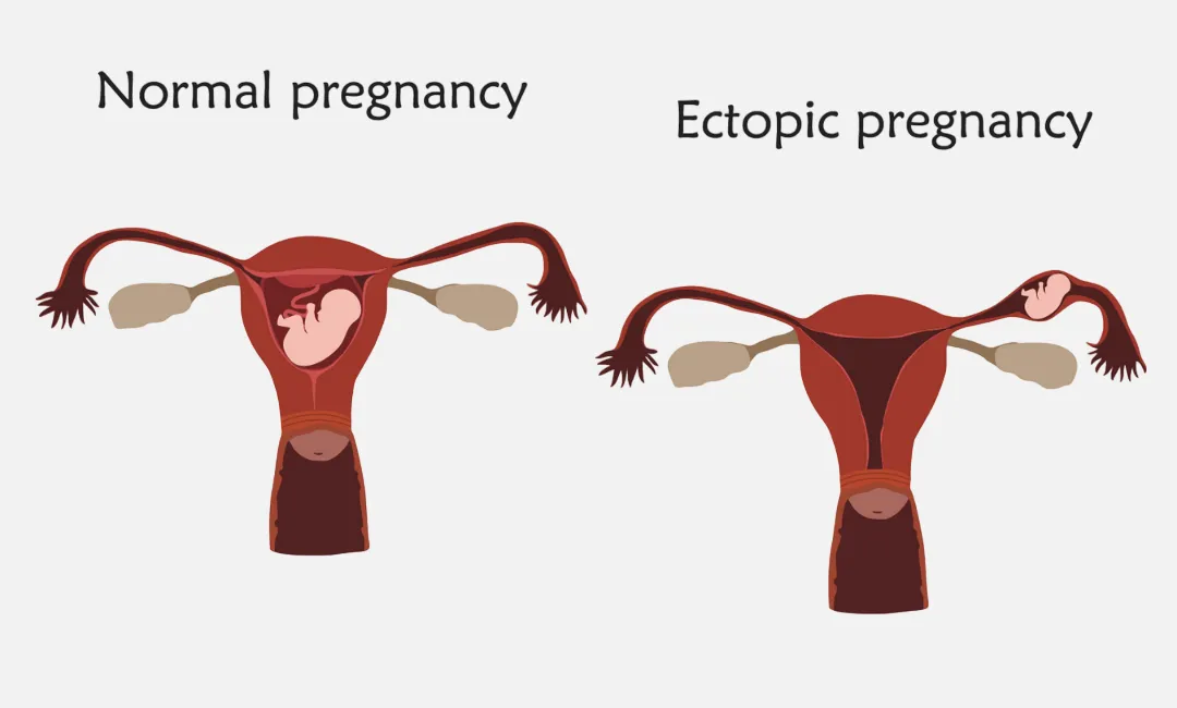 Normal Pregnancy and an Ectopic Pregnancy