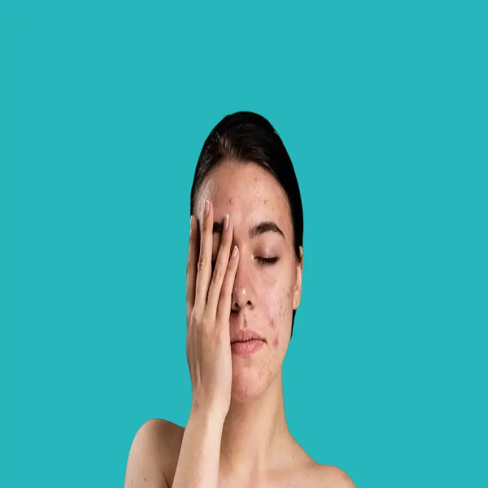 what is the difference between pimples and acne? 