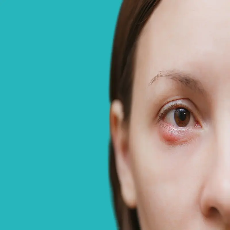 ما هو علاج دمل العين واسباب حدوثه؟ 