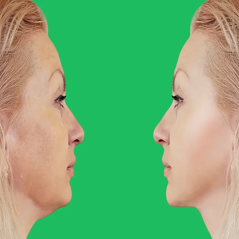 نظام غذائي لتقليل دهون الرقبة والذقن 