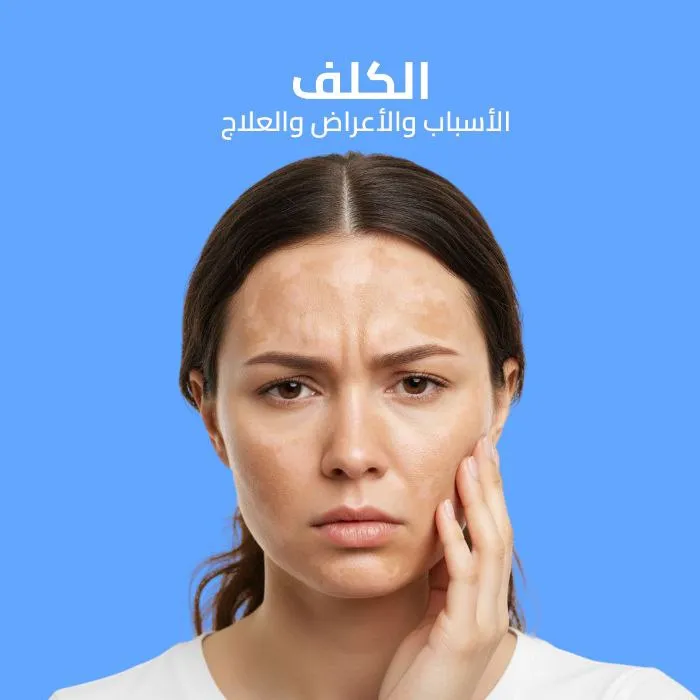 الكلف: الأسباب والأعراض والعلاج 