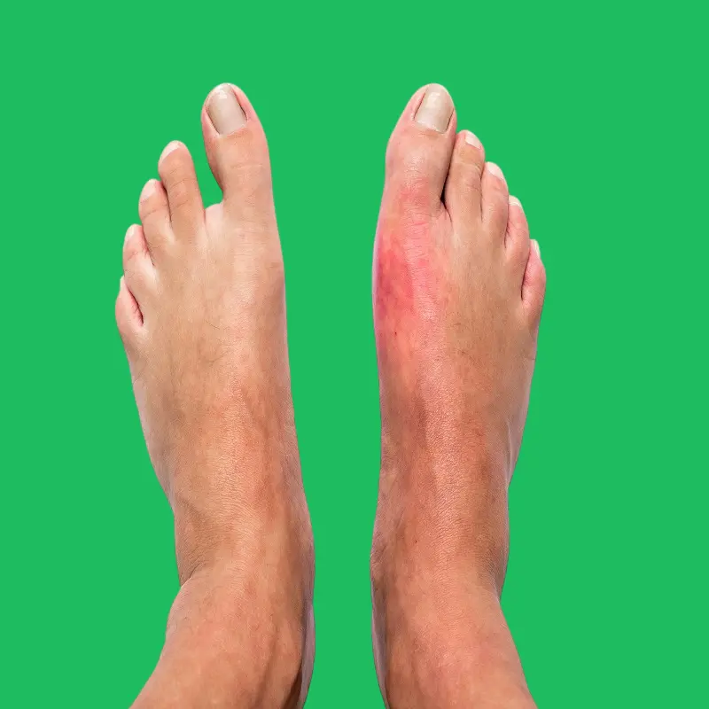 ما هو الدايت المناسب لمرضى النقرس؟ 