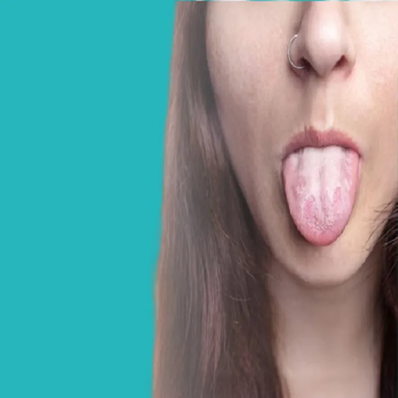 treatment methods and causes of candidiasis 