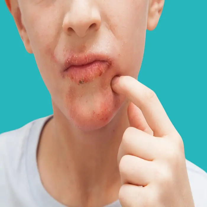 افضل كريم لعلاج القوباء عند الاطفال 