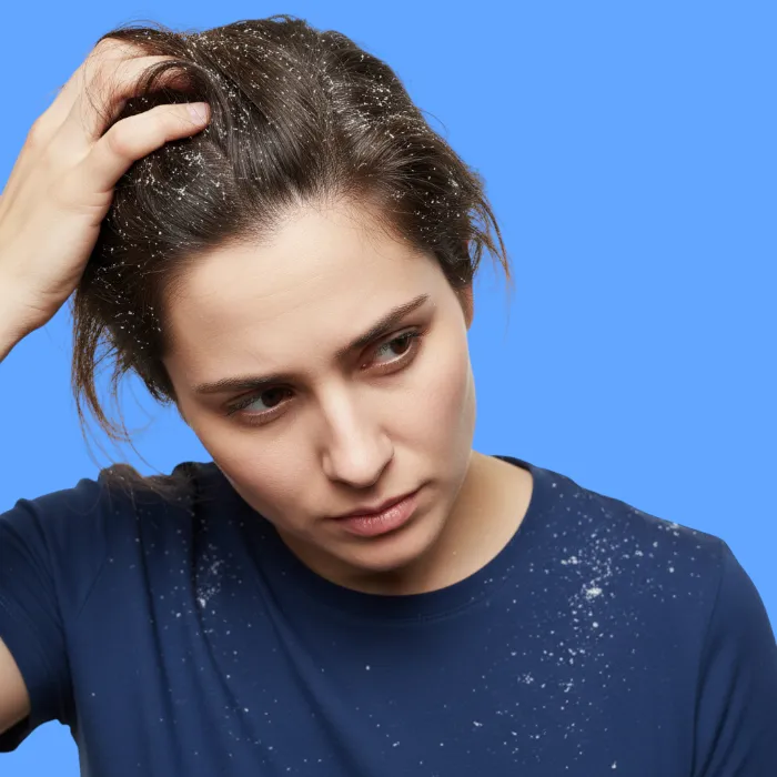 dandruff