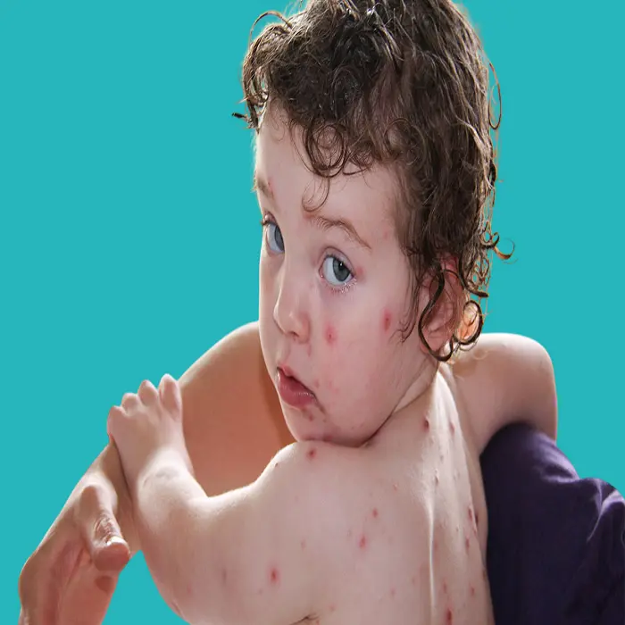 افضل دواء لعلاج الجدري المائي عند الاطفال 