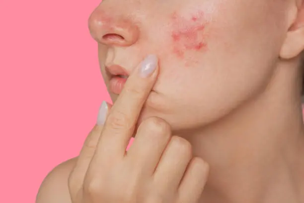 pimple creams for dry skin