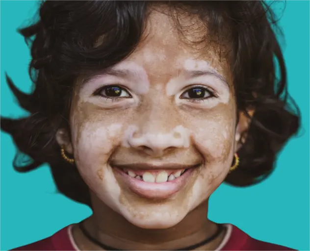 vitiligo