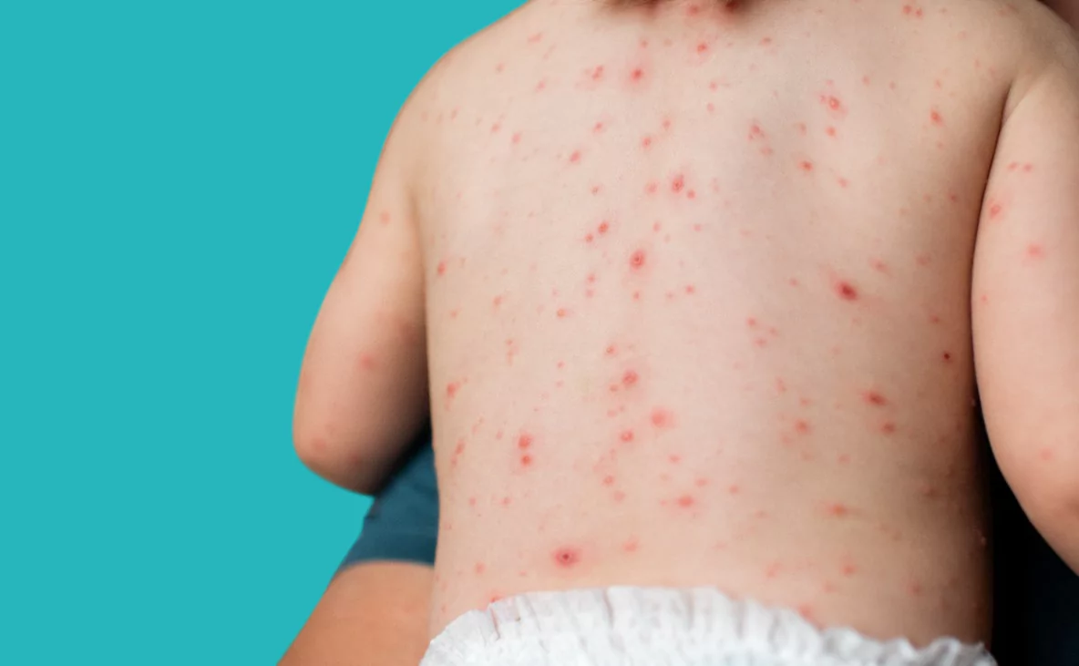 Scarlet Fever