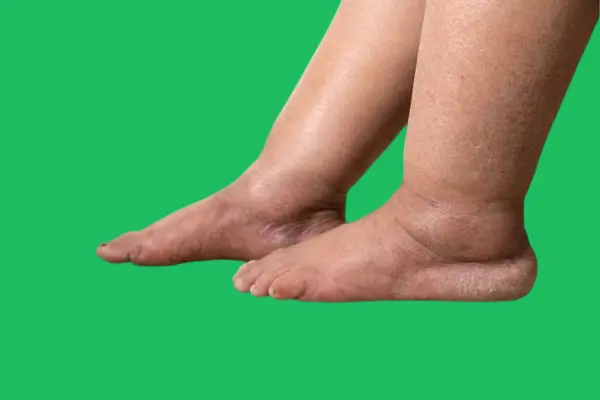 Body swelling due to excess water