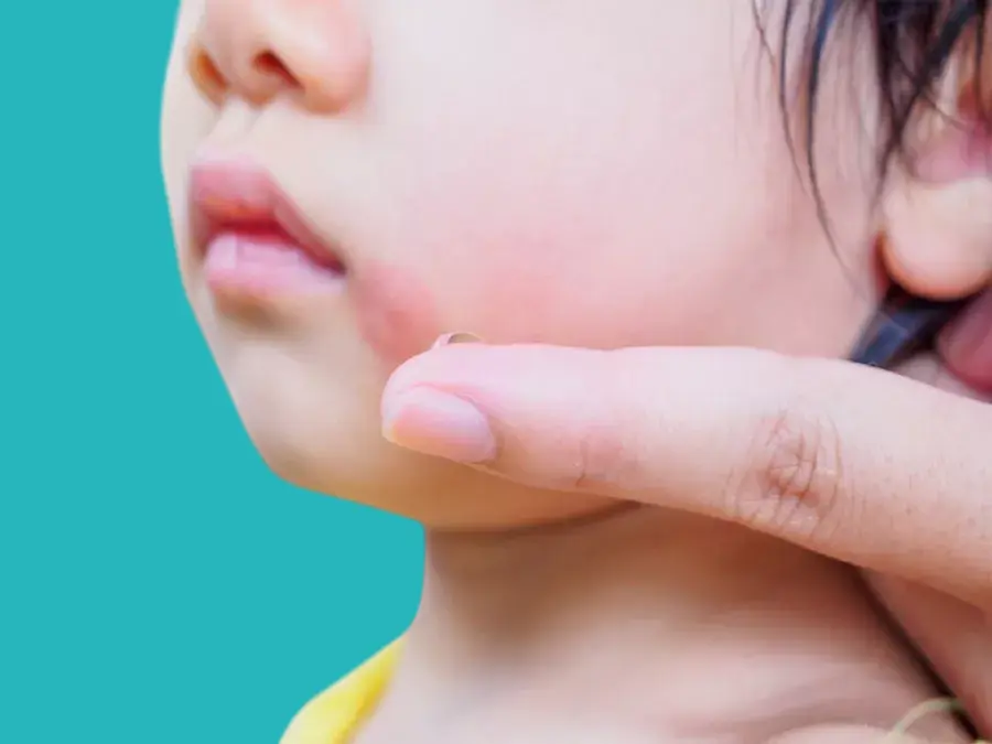 meningitis