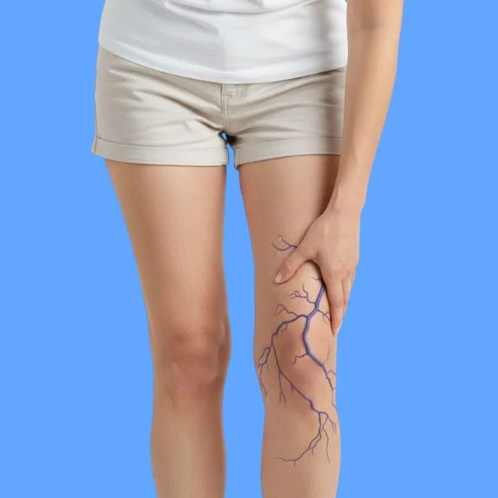 varicose veins: causes, symptoms, and treatment
