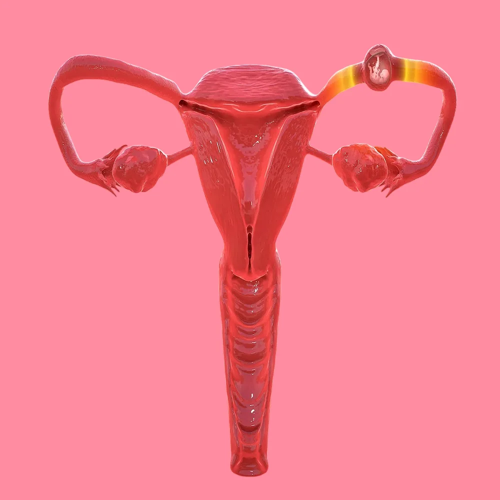 Causes of ectopic pregnancy and treatment methods 