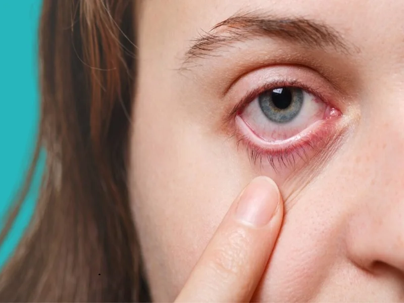 احمرار الجفن من اعراض انتفاخ العين