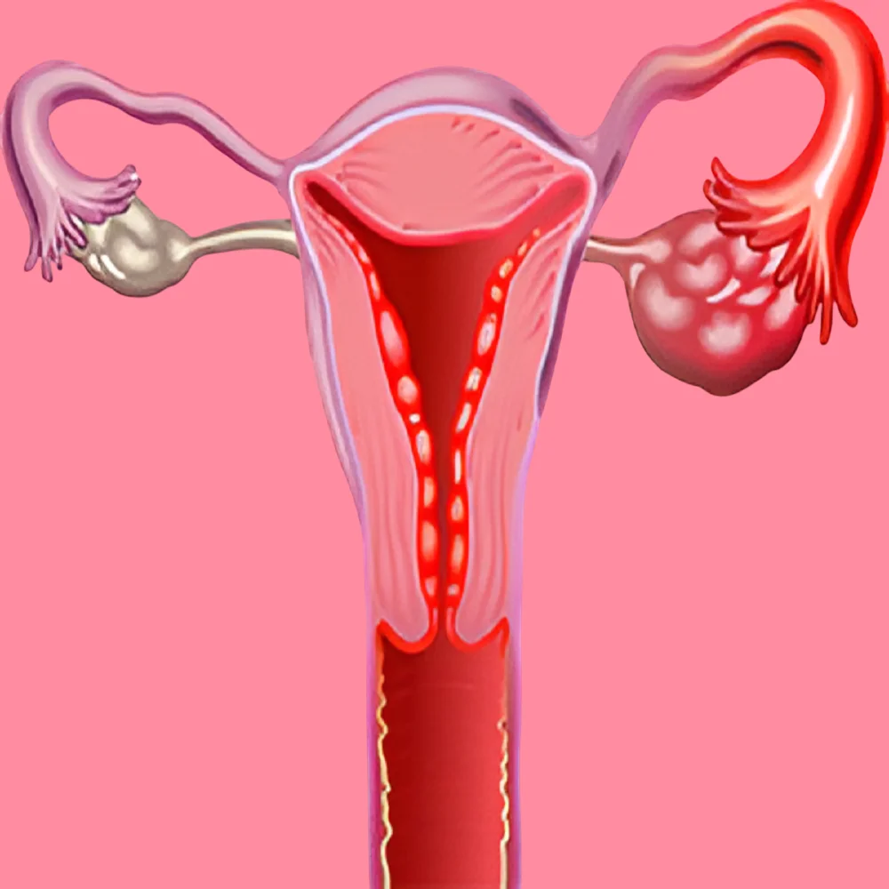 What are the symptoms of pelvic inflammatory disease in women and how is it treated? 