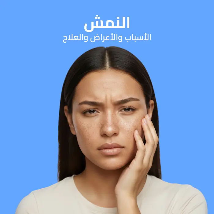 النمش: الأسباب والأعراض والعلاج 