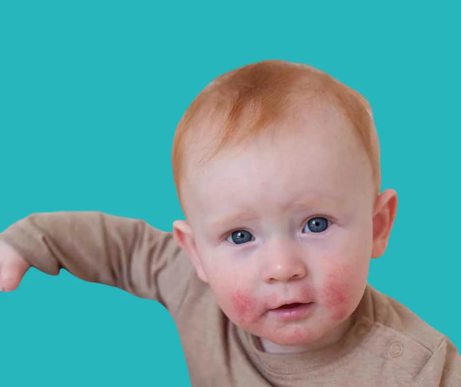 egg allergy
