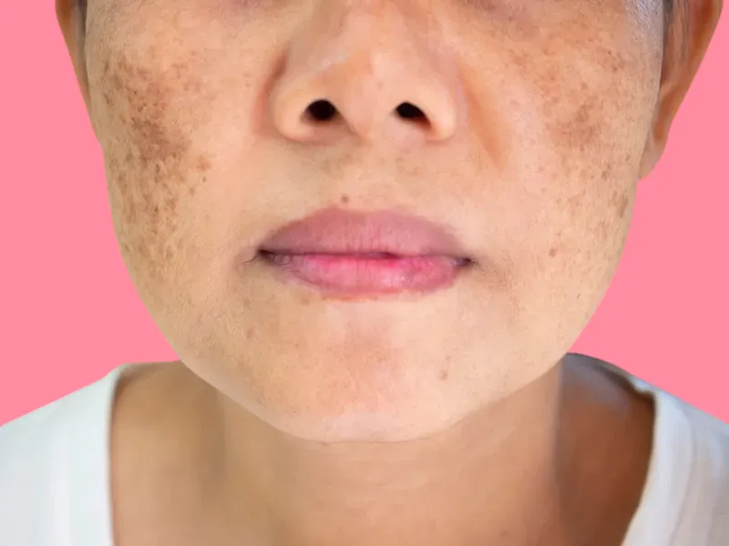 ظهور بقع داكنة على الجلد من اعراض كلف الحمل