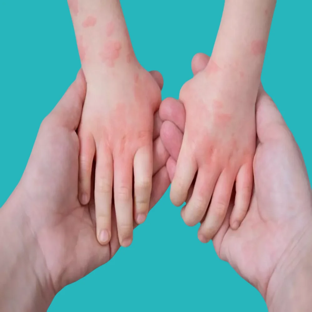 what is hand, foot, and mouth disease in children 