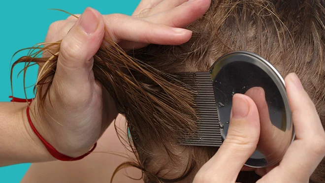 ازالة الصيبان