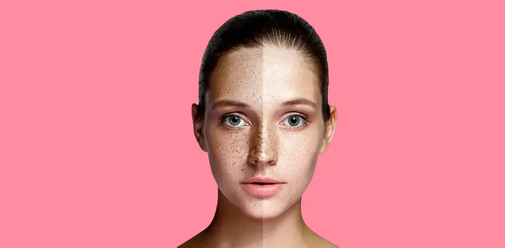 Melasma in women its causes and treatment 