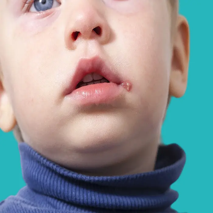 افضل دواء لعلاج الهربس الفموي عند الاطفال 