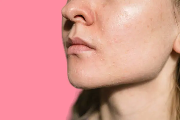 Skin care to combat dryness in winter