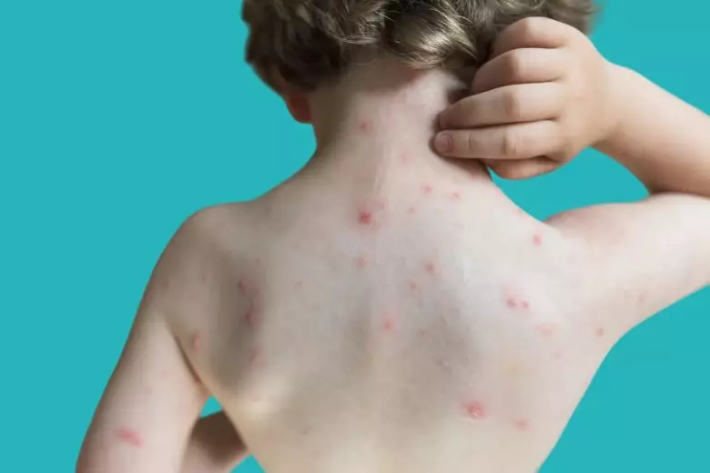 allergic dermatitis in children